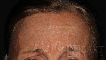BOTOX® Cosmetic Before - Paramus, NJ BOTOX® Cosmetic Before - Paramus, NJ