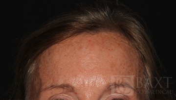 BOTOX® Cosmetic After - Paramus, NJ