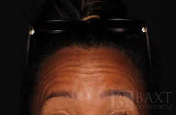 BOTOX® Cosmetic Before - Paramus, NJ BOTOX® Cosmetic Before - Paramus, NJ