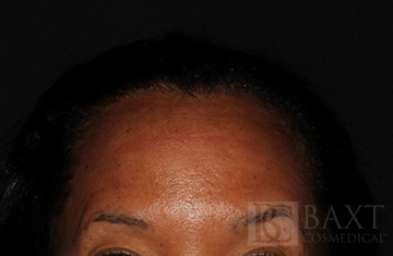 BOTOX® Cosmetic After - Paramus, NJ BOTOX® Cosmetic After - Paramus, NJ