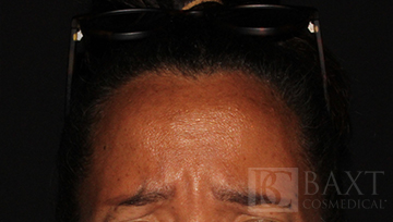BOTOX® Cosmetic Before - Paramus, NJ BOTOX® Cosmetic Before - Paramus, NJ