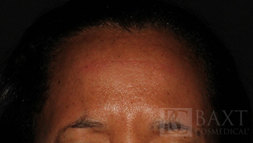 BOTOX® Cosmetic After - Paramus, NJ BOTOX® Cosmetic After - Paramus, NJ