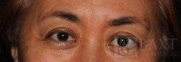BOTOX® Cosmetic Before - Paramus, NJ BOTOX® Cosmetic Before - Paramus, NJ
