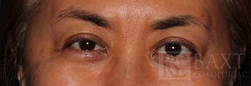 BOTOX® Cosmetic After - Paramus, NJ BOTOX® Cosmetic After - Paramus, NJ