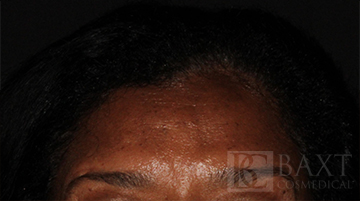 BOTOX® Cosmetic After - Paramus, NJ BOTOX® Cosmetic After - Paramus, NJ