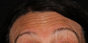 BOTOX® Cosmetic Before - Paramus, NJ BOTOX® Cosmetic Before - Paramus, NJ