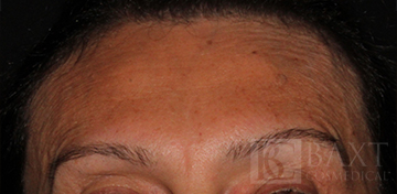 BOTOX® Cosmetic After - Paramus, NJ BOTOX® Cosmetic After - Paramus, NJ