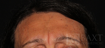 BOTOX® Cosmetic Before - Paramus, NJ BOTOX® Cosmetic Before - Paramus, NJ