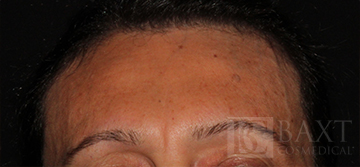 BOTOX® Cosmetic After - Paramus, NJ BOTOX® Cosmetic After - Paramus, NJ