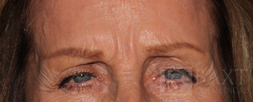 BOTOX® Cosmetic Before - Paramus, NJ BOTOX® Cosmetic Before - Paramus, NJ
