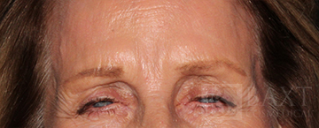 BOTOX® Cosmetic After - Paramus, NJ BOTOX® Cosmetic After - Paramus, NJ