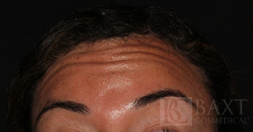 BOTOX® Cosmetic Before - Paramus, NJ BOTOX® Cosmetic Before - Paramus, NJ