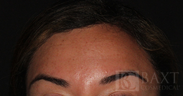 BOTOX® Cosmetic After - Paramus, NJ BOTOX® Cosmetic After - Paramus, NJ