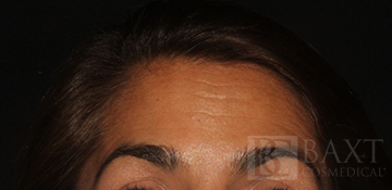 BOTOX® Cosmetic After - Paramus, NJ BOTOX® Cosmetic After - Paramus, NJ