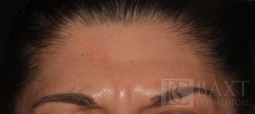 BOTOX® Cosmetic Before - Paramus, NJ BOTOX® Cosmetic Before - Paramus, NJ