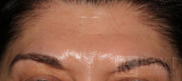 BOTOX® Cosmetic After - Paramus, NJ BOTOX® Cosmetic After - Paramus, NJ