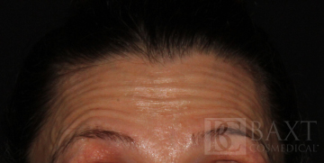 BOTOX® Cosmetic Before - Paramus, NJ BOTOX® Cosmetic Before - Paramus, NJ