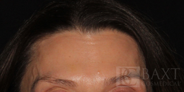 BOTOX® Cosmetic After - Paramus, NJ BOTOX® Cosmetic After - Paramus, NJ