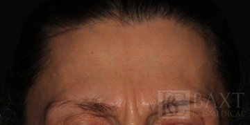 BOTOX® Cosmetic Before - Paramus, NJ BOTOX® Cosmetic Before - Paramus, NJ