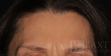 BOTOX® Cosmetic After - Paramus, NJ BOTOX® Cosmetic After - Paramus, NJ