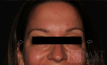 BOTOX® Cosmetic After - Paramus, NJ BOTOX® Cosmetic After - Paramus, NJ