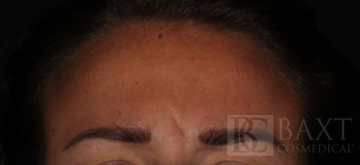 BOTOX® Cosmetic Before - Paramus, NJ BOTOX® Cosmetic Before - Paramus, NJ