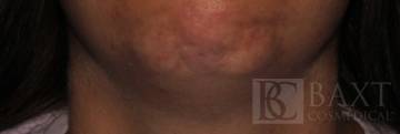 BOTOX® Cosmetic Before - Paramus, NJ BOTOX® Cosmetic Before - Paramus, NJ