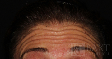BOTOX® Cosmetic Before - Paramus, NJ BOTOX® Cosmetic Before - Paramus, NJ