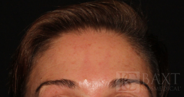 BOTOX® Cosmetic After - Paramus, NJ BOTOX® Cosmetic After - Paramus, NJ