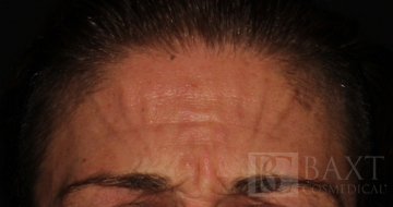 BOTOX® Cosmetic Before - Paramus, NJ BOTOX® Cosmetic Before - Paramus, NJ