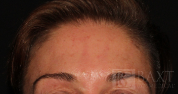 BOTOX® Cosmetic After - Paramus, NJ BOTOX® Cosmetic After - Paramus, NJ