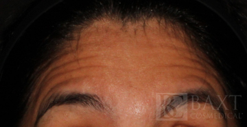 BOTOX® Cosmetic Before - Paramus, NJ BOTOX® Cosmetic Before - Paramus, NJ