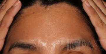 BOTOX® Cosmetic After - Paramus, NJ BOTOX® Cosmetic After - Paramus, NJ