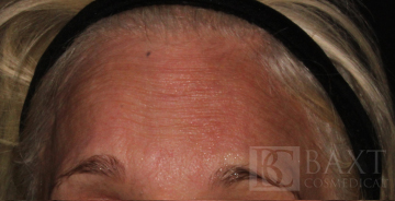 BOTOX® Cosmetic Before - Paramus, NJ BOTOX® Cosmetic Before - Paramus, NJ