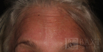 BOTOX® Cosmetic After - Paramus, NJ BOTOX® Cosmetic After - Paramus, NJ