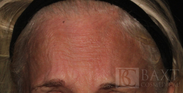 BOTOX® Cosmetic Before - Paramus, NJ BOTOX® Cosmetic Before - Paramus, NJ