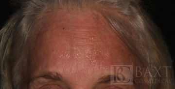 BOTOX® Cosmetic After - Paramus, NJ BOTOX® Cosmetic After - Paramus, NJ