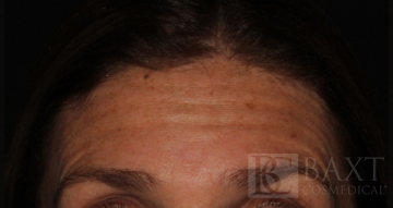 BOTOX® Cosmetic Before - Paramus, NJ BOTOX® Cosmetic Before - Paramus, NJ