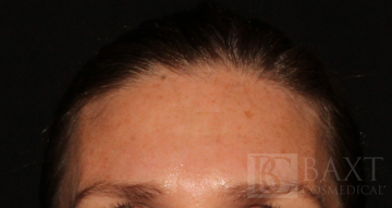 BOTOX® Cosmetic After - Paramus, NJ BOTOX® Cosmetic After - Paramus, NJ