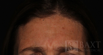 BOTOX® Cosmetic Before - Paramus, NJ BOTOX® Cosmetic Before - Paramus, NJ
