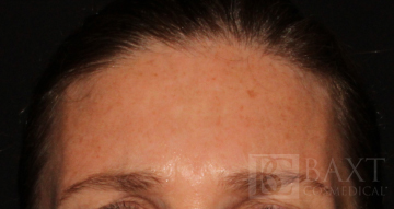 BOTOX® Cosmetic After - Paramus, NJ BOTOX® Cosmetic After - Paramus, NJ