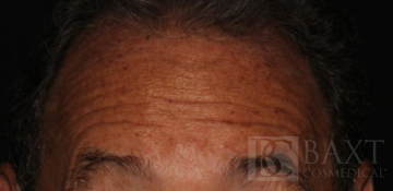 BOTOX® Cosmetic Before - Paramus, NJ BOTOX® Cosmetic Before - Paramus, NJ