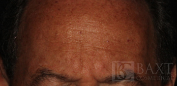 BOTOX® Cosmetic After - Paramus, NJ BOTOX® Cosmetic After - Paramus, NJ