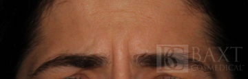 BOTOX® Cosmetic Before - Paramus, NJ BOTOX® Cosmetic Before - Paramus, NJ