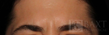 BOTOX® Cosmetic After - Paramus, NJ BOTOX® Cosmetic After - Paramus, NJ