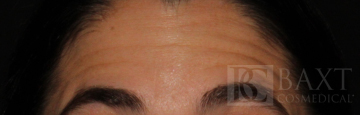BOTOX® Cosmetic Before - Paramus, NJ BOTOX® Cosmetic Before - Paramus, NJ