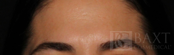 BOTOX® Cosmetic After - Paramus, NJ BOTOX® Cosmetic After - Paramus, NJ