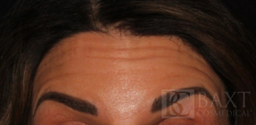 BOTOX® Cosmetic Before - Paramus, NJ BOTOX® Cosmetic Before - Paramus, NJ