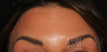 BOTOX® Cosmetic After - Paramus, NJ BOTOX® Cosmetic After - Paramus, NJ
