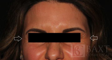 BOTOX® Cosmetic Before - Paramus, NJ BOTOX® Cosmetic Before - Paramus, NJ